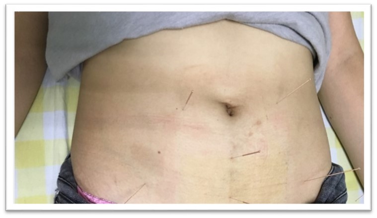 调经促孕丸中药,调经促孕十三针