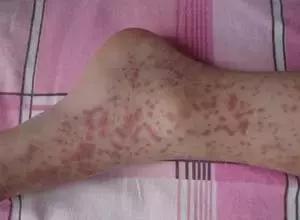 再障造血干细胞移植,新桥医院重型再障造血干细胞移植