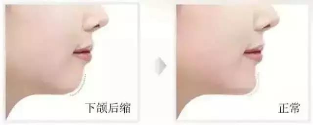 儿童口腔科正畸多大可以做,口腔戴牙套需要无菌操作么