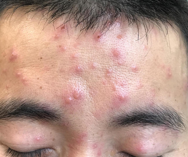 得了皮肤病不要怕,五种常见的皮肤病一分钟教你应对