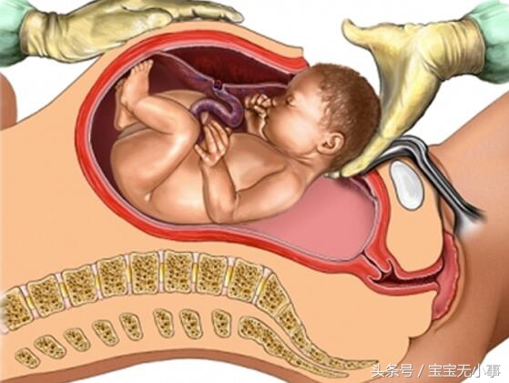 顺产误区,剖腹产和顺产到底该如何选择