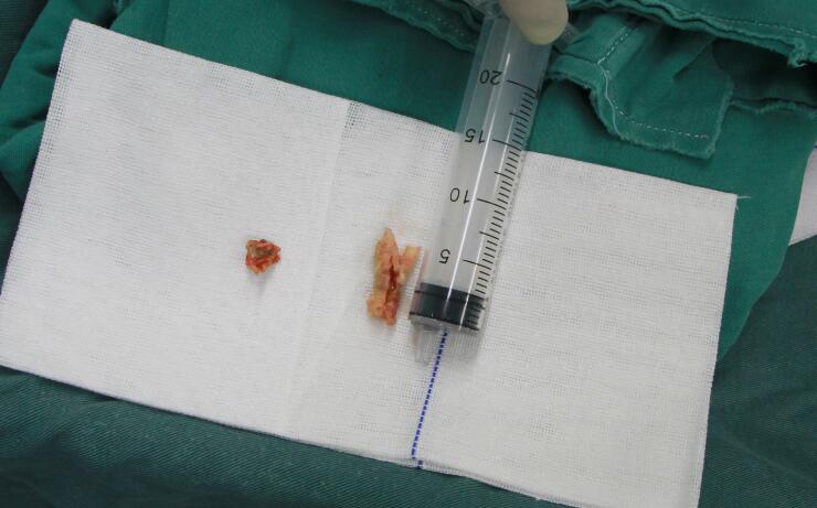 七旬老人颈动脉狭窄手术,颈动脉狭窄做剥脱属于大手术吗