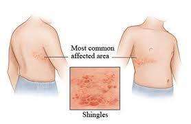 突然起皮疹是什么原因,皮疹是什么原因引起的