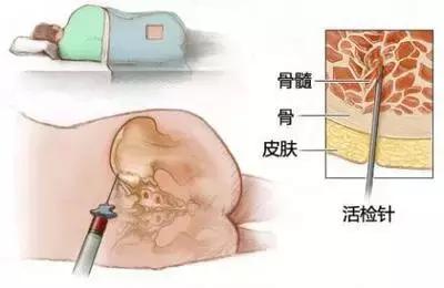 再障造血干细胞移植,新桥医院重型再障造血干细胞移植