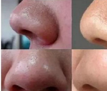 药店里十几块钱的粉末涂在鼻子上，只用几次黑头就连根拔起