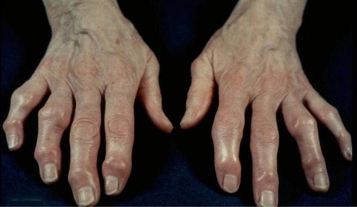 风湿性关节炎喝酒的严重后果,关节炎和风湿性关节炎的区别