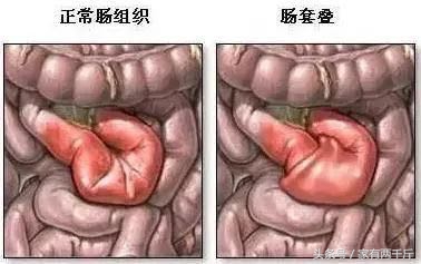 宝宝莫名哭闹小心是肠绞痛,宝宝异常哭闹睡不踏实