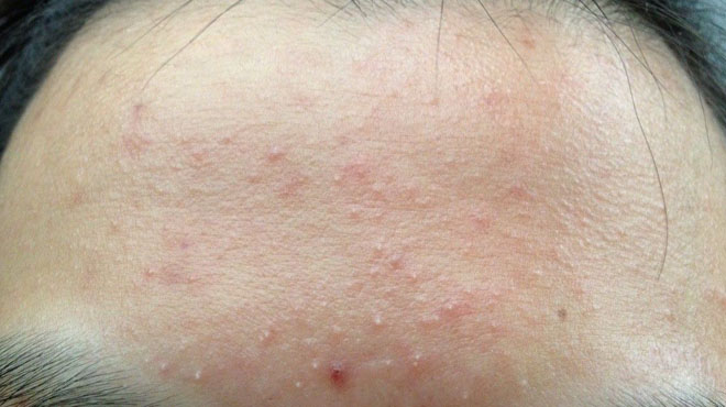 肝部位长红痣是什么原因不痛不痒,身上长红痣是肝出现问题了吗