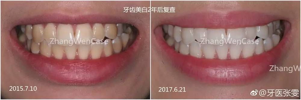 牙齿美白损伤最少的方法,想要牙齿美白这三招最管用