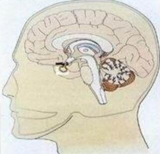 小孩颅咽管瘤真实治愈率,颅咽管瘤算不算重大疾病