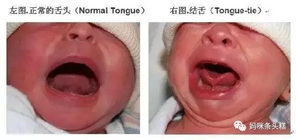 宝宝吐字不清训练方法,怎么样判断宝宝说话不清舌系带短