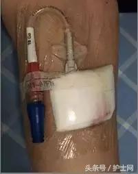 更换敷贴的操作视频,怎么换敷贴