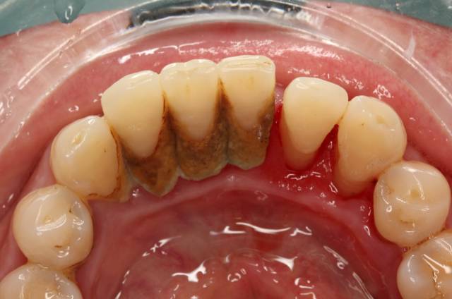 从来都没洗过牙的视频,有多少人从来没有洗过牙