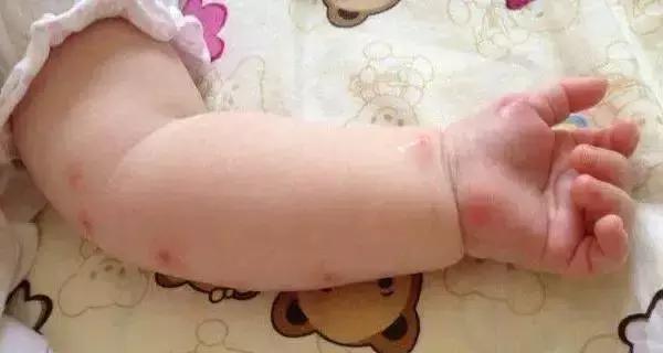 宝宝被蚊子咬了大包怎么处理,为什么皮肤被蚊子咬后起了很大包