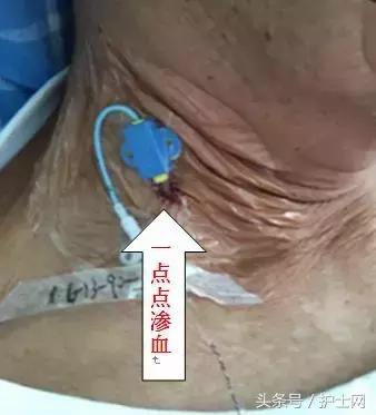 更换敷贴的操作视频,怎么换敷贴