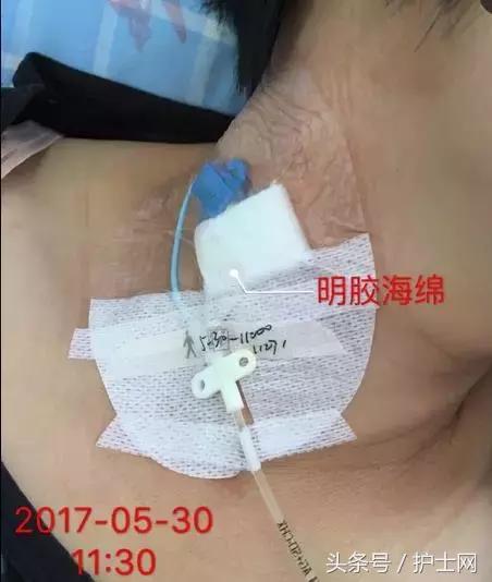 更换敷贴的操作视频,怎么换敷贴
