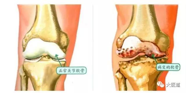 老人膝盖疼痛的原因和治疗方法,人未老腿膝盖疼怎么办