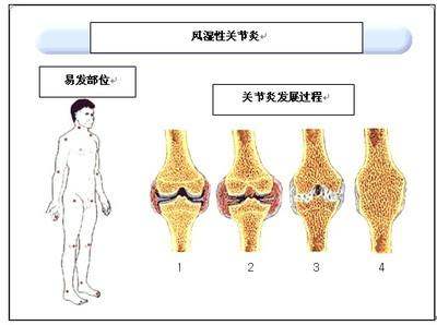 风湿性关节炎喝酒的严重后果,关节炎和风湿性关节炎的区别