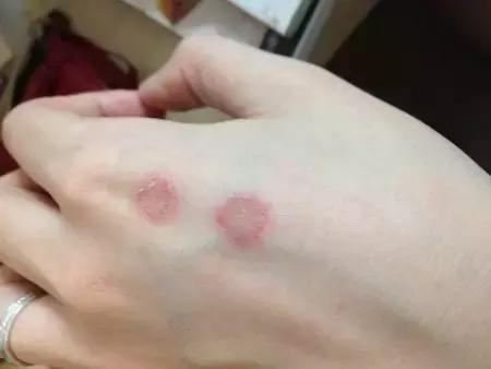 人得猫癣怎么治疗最快,猫得猫癣的原因是什么