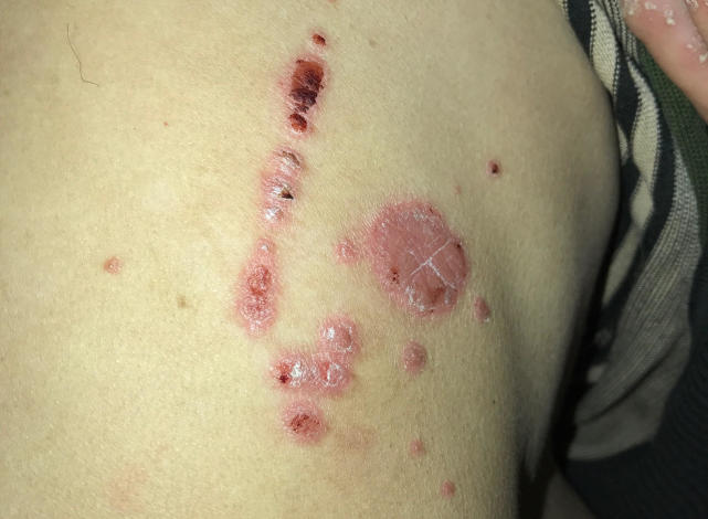 得了皮肤病不要怕,五种常见的皮肤病一分钟教你应对