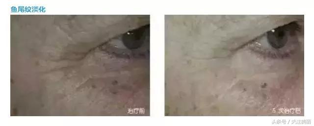 玻尿酸填充真的会好看吗,玻尿酸填充是不是越来越丑