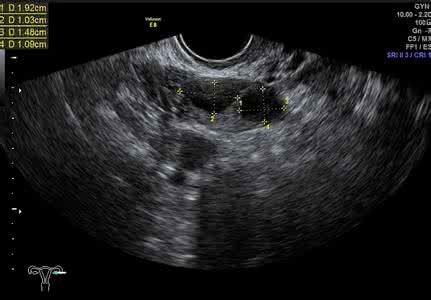 给备孕中的卵巢评个分
