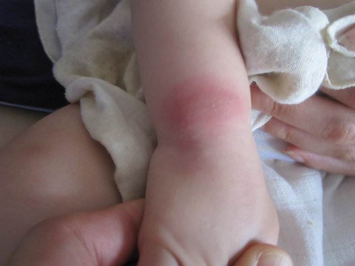 宝宝被蚊子咬了大包怎么处理,为什么皮肤被蚊子咬后起了很大包