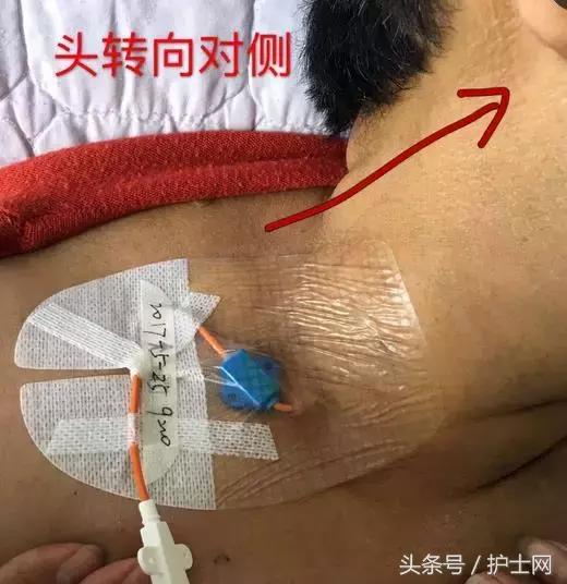 更换敷贴的操作视频,怎么换敷贴