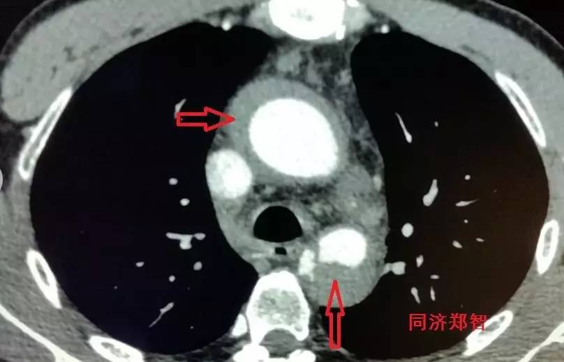 主动脉夹层差点要了老公的命,主动脉夹层兄妹