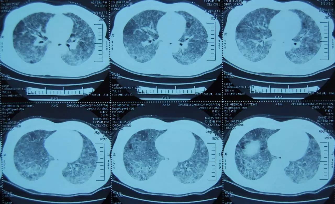 喘息、呼衰1年,问病史才发现是这个病!