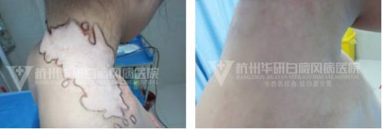 「无限白斑泪谁言患者心」白癜风能治好吗？他说能！
