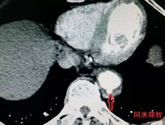 主动脉夹层差点要了老公的命,主动脉夹层兄妹