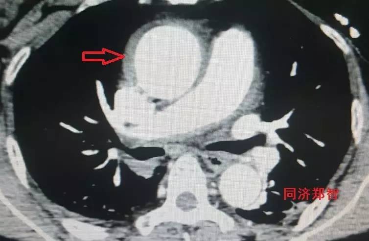 主动脉夹层差点要了老公的命,主动脉夹层兄妹