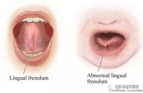 宝宝舌头w型是舌系带短吗,怎么看孩子舌头系带是不是短