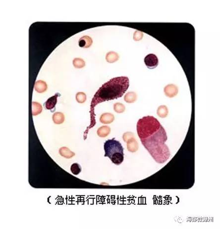 全身酸痛乏力流鼻涕高烧,大人身体消瘦流鼻血怎么回事