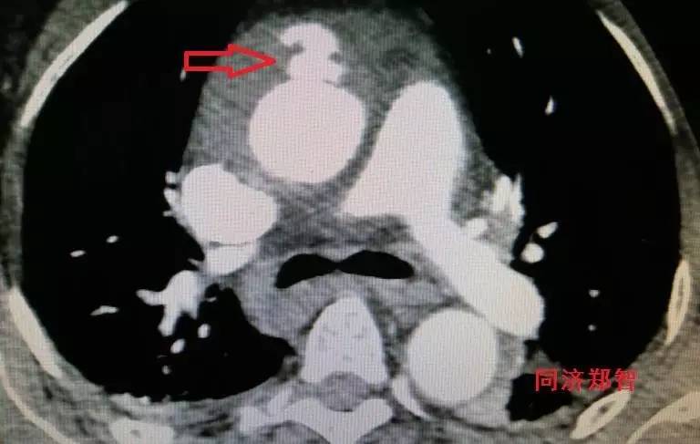 主动脉夹层差点要了老公的命,主动脉夹层兄妹
