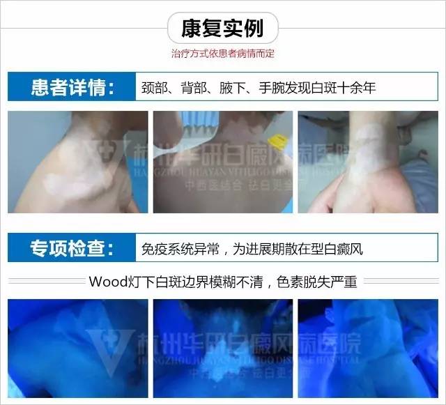 「无限白斑泪谁言患者心」白癜风能治好吗？他说能！