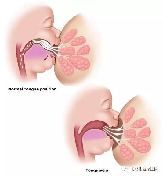 宝宝舌头w型是舌系带短吗,怎么看孩子舌头系带是不是短