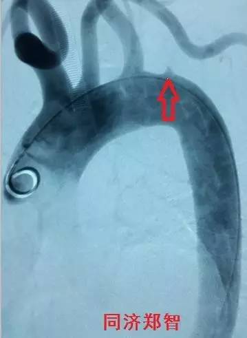 主动脉夹层差点要了老公的命,主动脉夹层兄妹