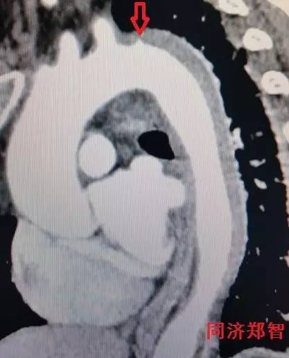 主动脉夹层差点要了老公的命,主动脉夹层兄妹