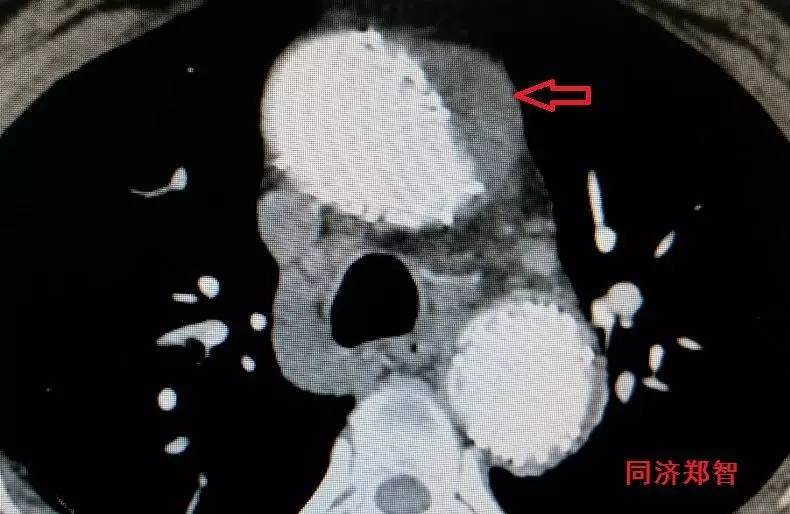 主动脉夹层差点要了老公的命,主动脉夹层兄妹