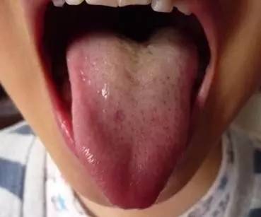 小儿舌苔白腻,小儿斑驳舌苔