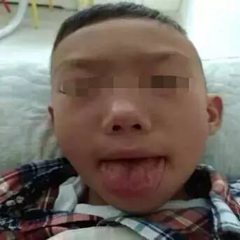 小儿舌苔白腻,小儿斑驳舌苔