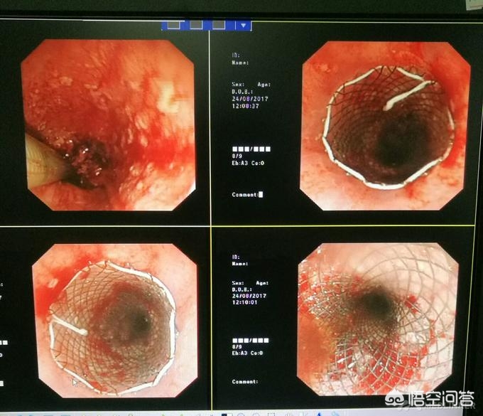 食管癌晚期食道梗阻怎么治,食道癌晚期食道堵塞怎么解决