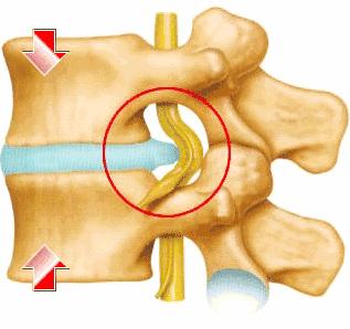 什么是腰椎间盘膨出，为什么会感到下肢酸麻胀痛