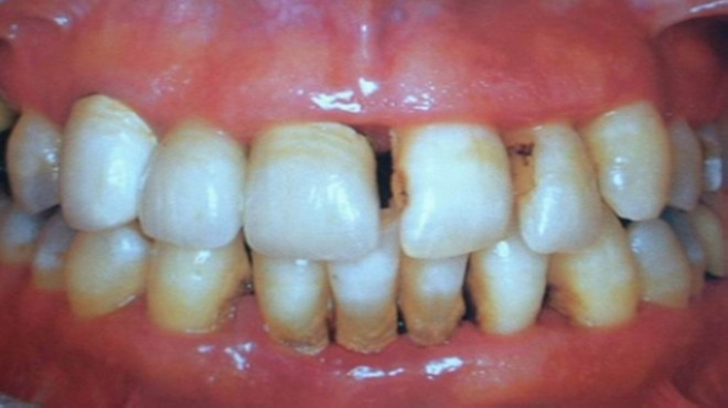 儿童牙齿缝隙越来越大是什么原因,中年女人牙齿缝隙越来越大怎么办