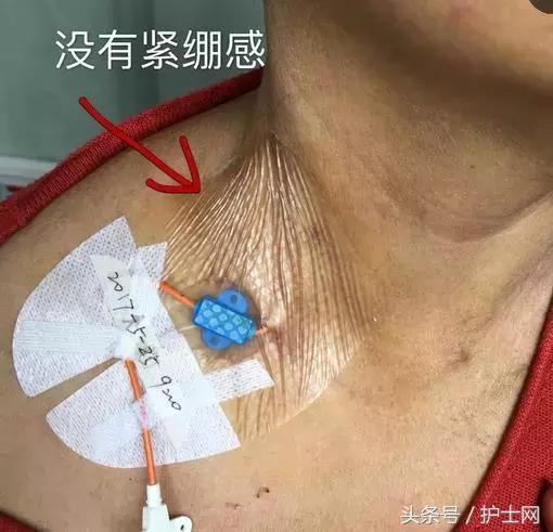 更换敷贴的操作视频,怎么换敷贴