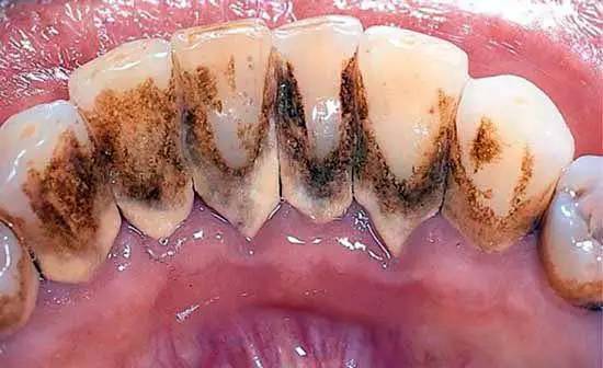 从来都没洗过牙的视频,有多少人从来没有洗过牙