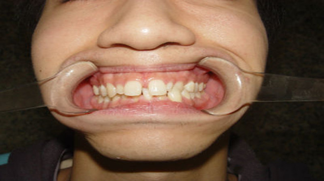 儿童牙齿缝隙越来越大是什么原因,中年女人牙齿缝隙越来越大怎么办