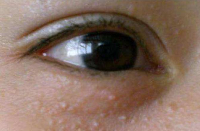 长了脂肪粒脂肪粒如何调理？免费教您2招轻松改善根除脂肪粒